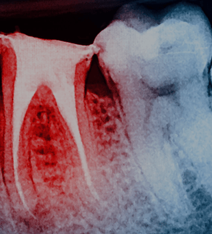 Treatment - Cosmetic & Family Dentistry