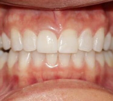 After - Cosmetic & Family Dentistry