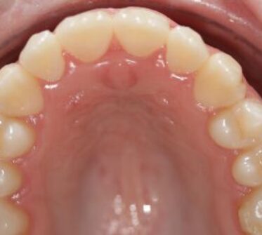 After - Cosmetic & Family Dentistry