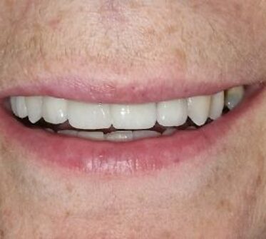 After - Cosmetic & Family Dentistry