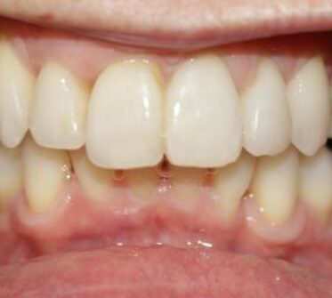 After - Cosmetic & Family Dentistry
