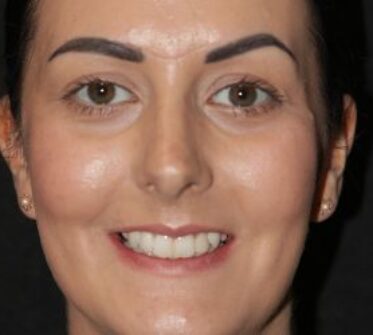 After - Cosmetic & Family Dentistry