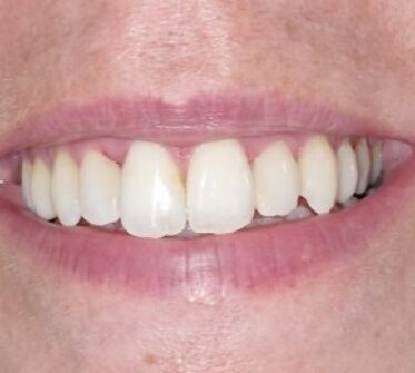 After - Cosmetic & Family Dentistry