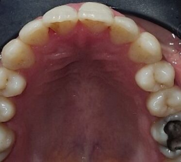 After - Cosmetic & Family Dentistry