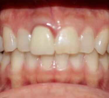 Before - Cosmetic & Family Dentistry