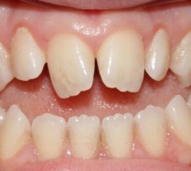 Before - Cosmetic & Family Dentistry