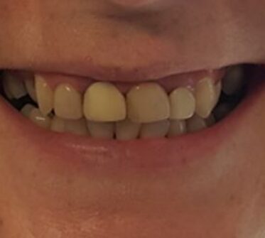 Before - Cosmetic & Family Dentistry