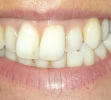 Before - Cosmetic & Family Dentistry